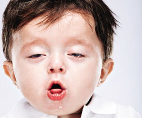 过敏性咳嗽症状有哪些更好的辨别小儿过敏性咳嗽