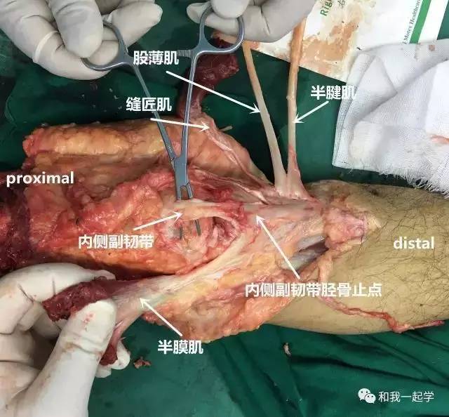 图 7 实战解剖的意义 术中切取鹅足肌腱时采取的是小切口,仅可观察到