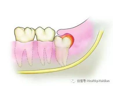 健康谈|智齿该不该拔?