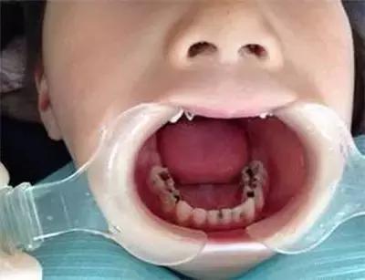 知道这个,宝贝的牙齿就不会坏啦!