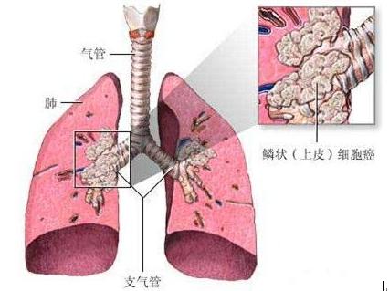 pik3ca 突变:肺鳞癌的一种预后因素