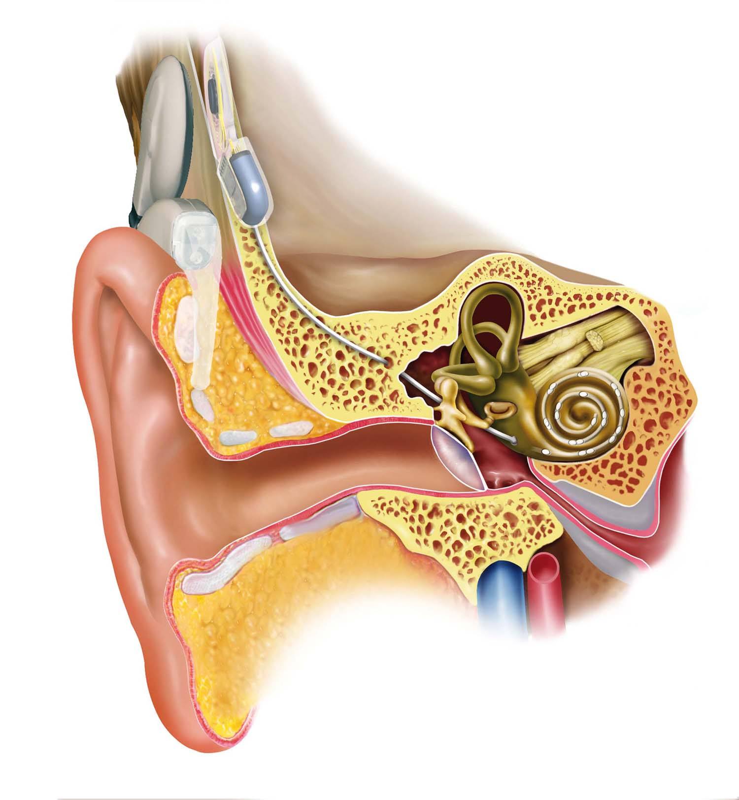 人工耳蜗植入前听障儿童家长该做什么？ - 中国助听器行业网