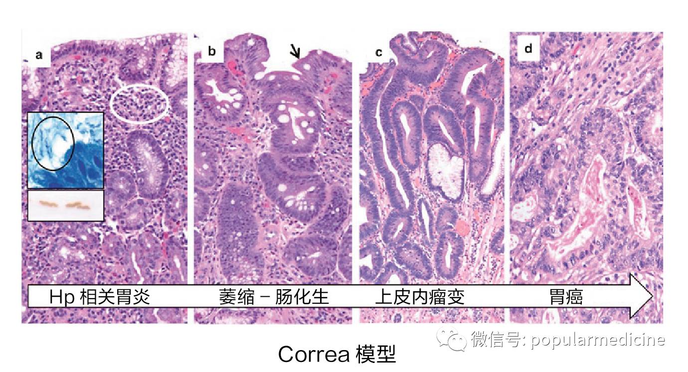 幽门螺杆菌阳性,要不要赶尽杀绝?