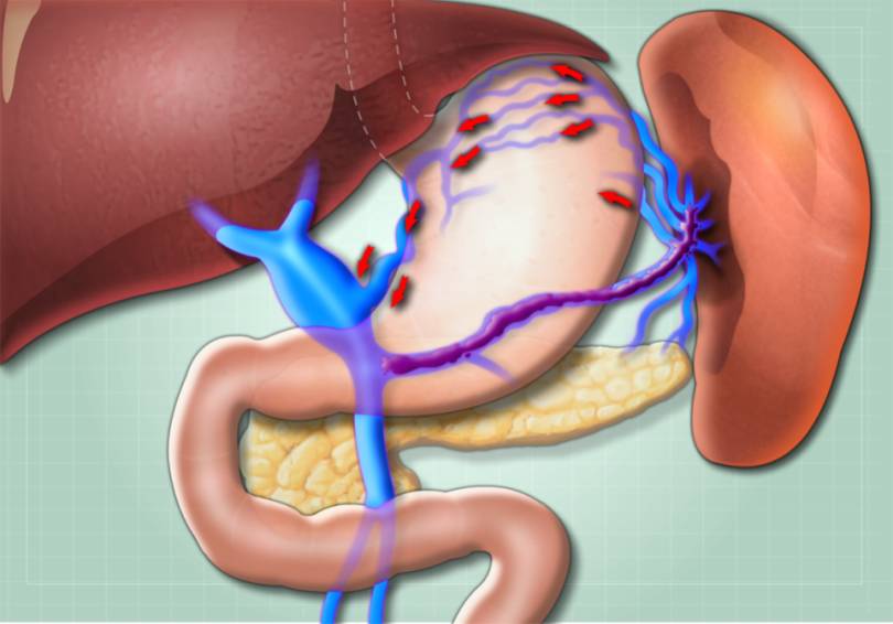 脾静脉阻塞→静脉血液回流受阻→侧枝循环形成→胃底静脉曲张→胃冠状