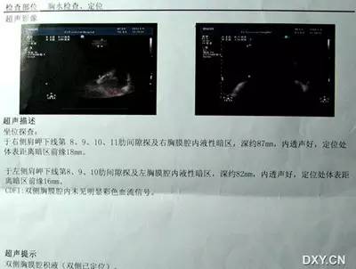 ct胸片b超临床之争揭开胸水定位之谜