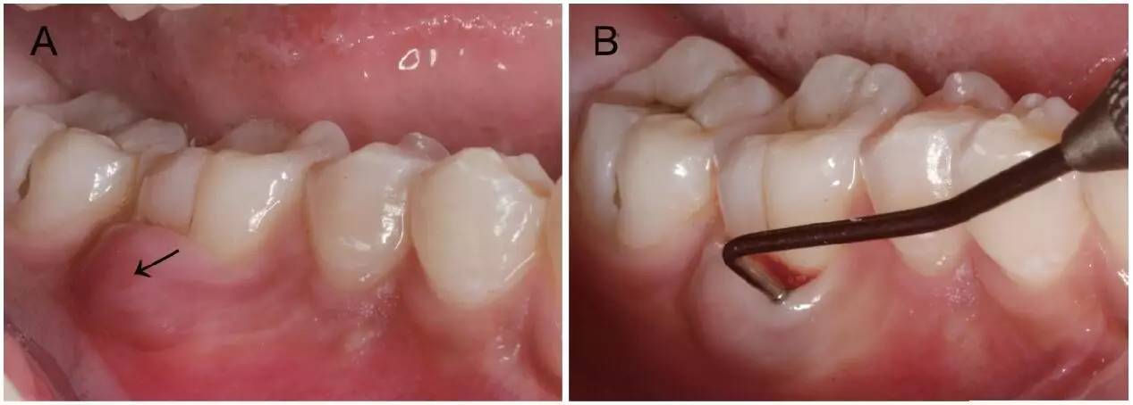 【慢性根尖炎罕见表现】窦道开口于健康邻牙龈沟一例