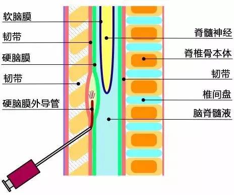 吗啡的原理_吗啡泵的工作原理   鞘内吗啡泵的工作原理是将一根极细的硅胶导管通过穿刺针放(3)