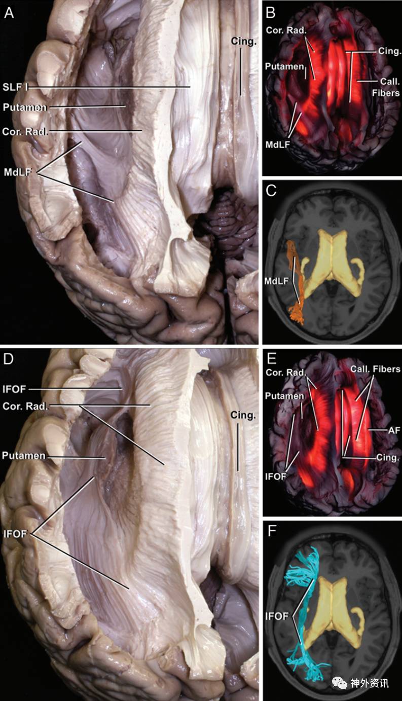 大脑白质纤维束与侧脑室手术(二)