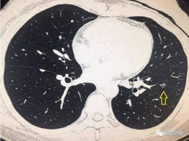 福州依姐被查出早期肺癌,多名医生不敢手术,多