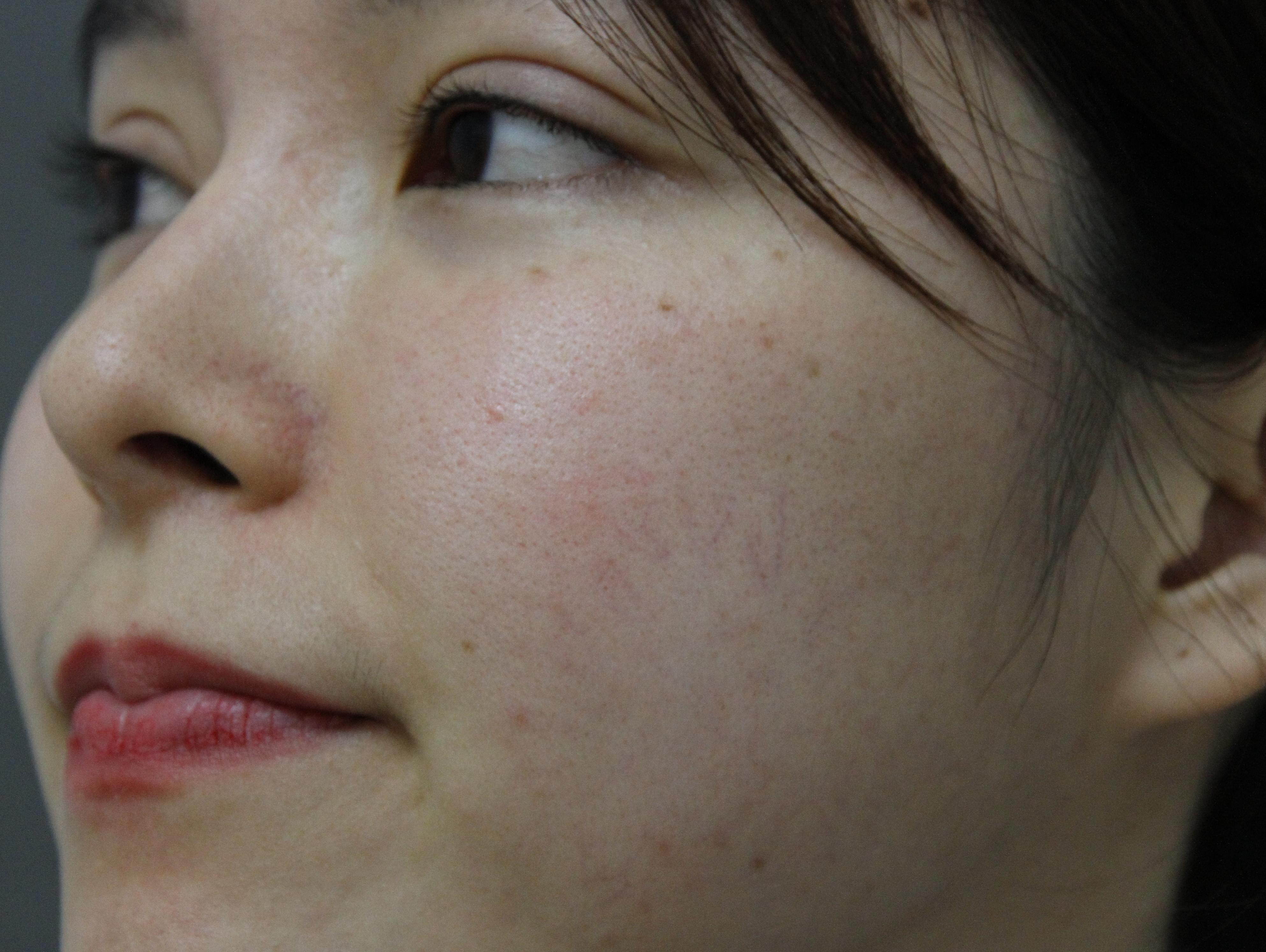 脸上有红血丝、皮肤容易过敏、有什么护肤品可以推荐吗？ - 知乎