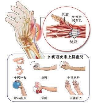 狭窄性腱鞘炎(腕关节炎)症状及艾灸穴位方法