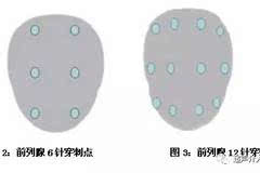 超声引导下前列腺穿刺活检