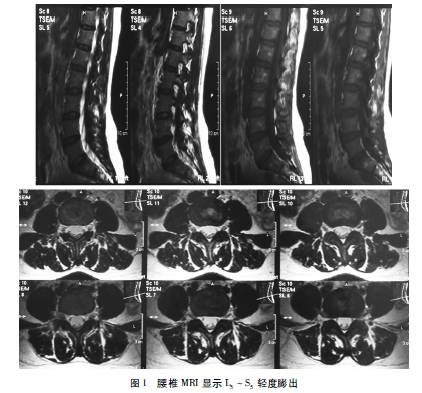 性改变;(2)t11,12,l4,5s1椎间盘变性,t11,12,l5s1椎间盘轻度突出(图1)