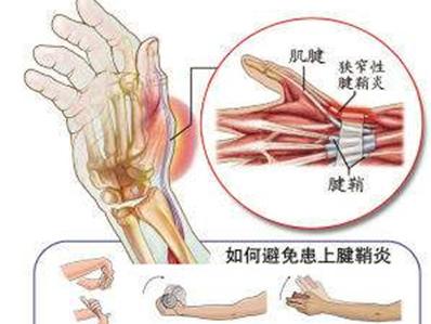 首页 中医养生 正文 腱鞘是包绕肌腱的鞘状结构.