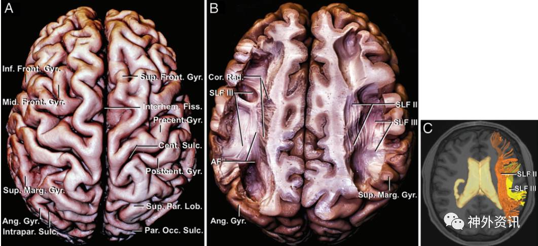 大脑白质纤维束与侧脑室手术(二)