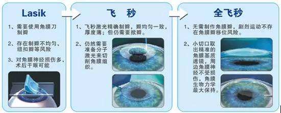 全面解析全飞秒与飞秒近视手术方式_健康_南