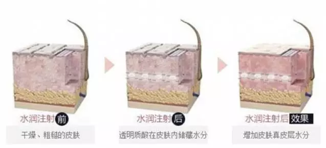 玻尿酸的原理是什么_玻尿酸的原理