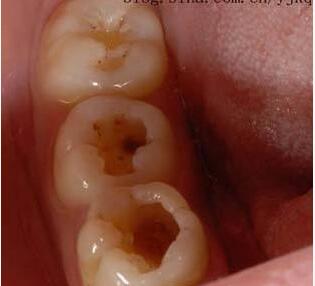人的牙齿为什么会生虫子?