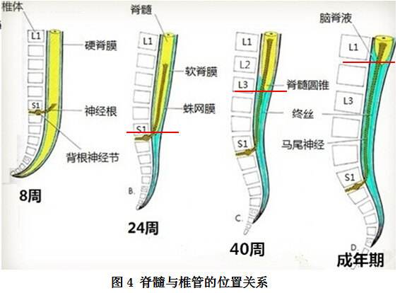位置升高,新生儿脊髓终止于l3下缘,成人则在l1-2椎体水平,圆锥下方缩