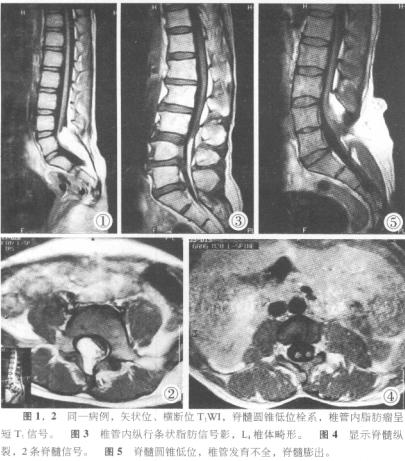 脊髓拴系综合征