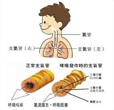 哮喘的原理_既然知道了哮喘的发病机制,我们就一步一步来看看都可以怎么治疗   首先,哮喘是