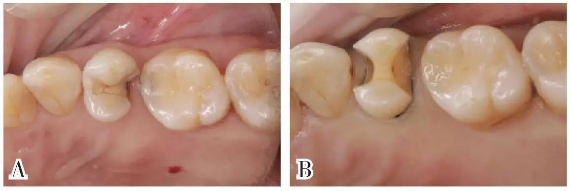 邻 牙合面双面嵌体牙体预备后 牙合面形态,传统固位理念具有鸠尾结构