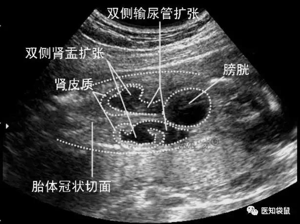 产检b超:怎么看胎儿是否畸形?
