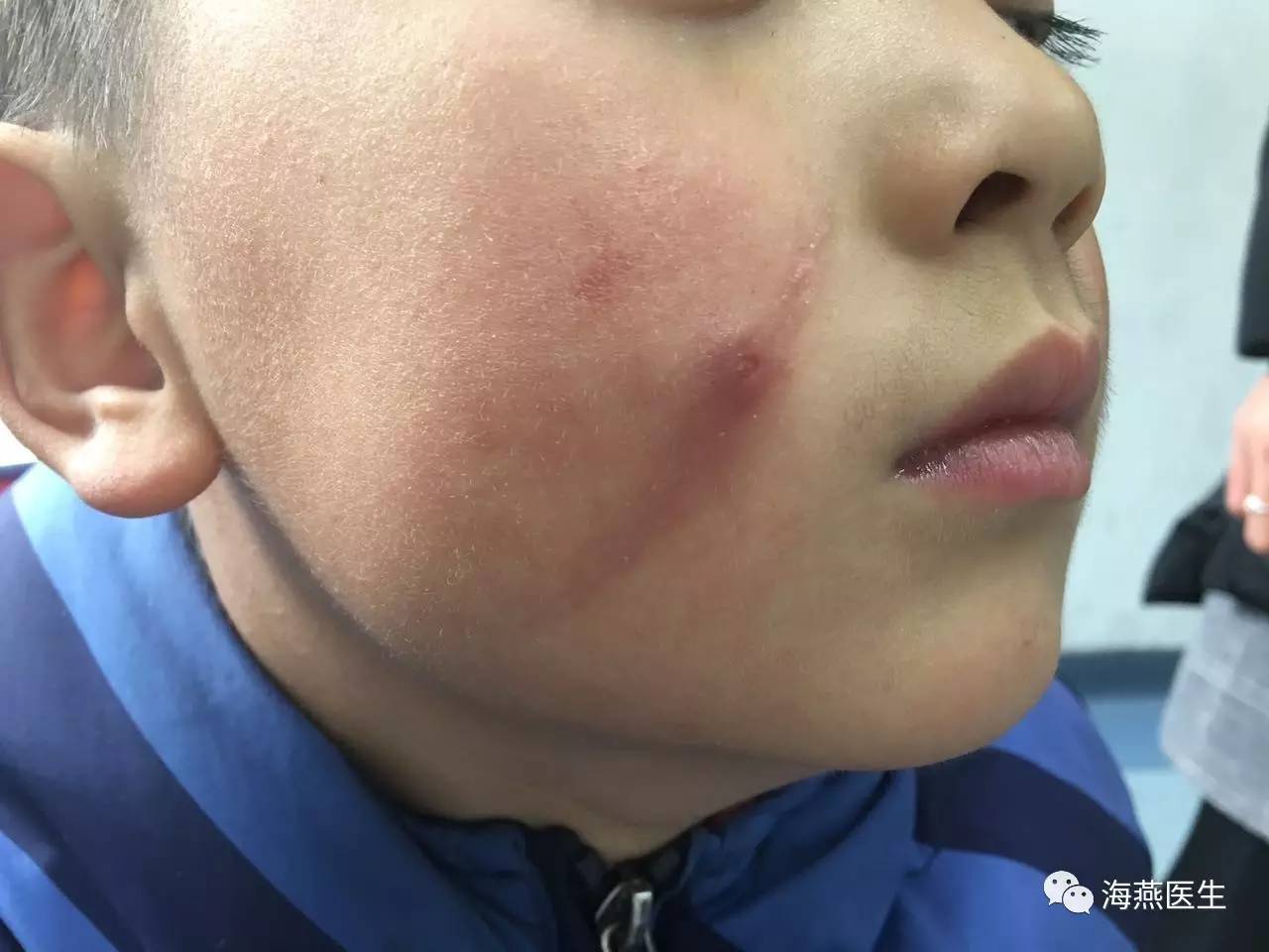 医院故事|孩子的脸为啥肿了?