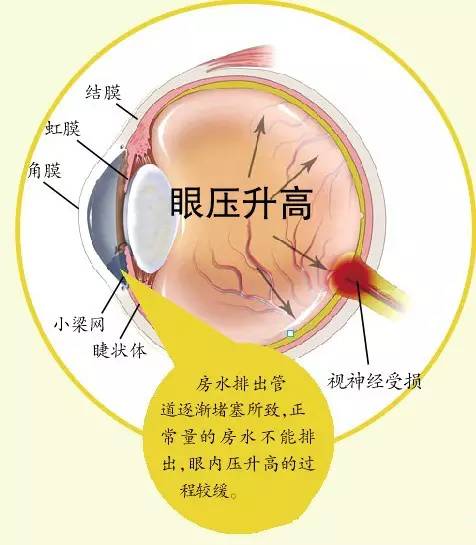 青光眼的分类