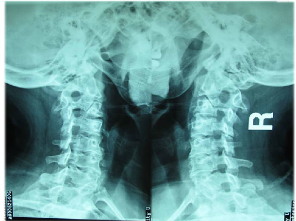 颈椎正侧位x光片颈椎x线片包括颈椎的正位片和侧位片,主要是看颈椎