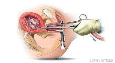 五个月流产的胎儿图