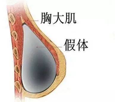 发达国家的乳腺癌患者接受乳房再造的比例已接近80,因此对于手术效果