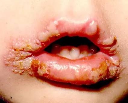 图片来自美国疾病预防控制中心cdc网站 口唇疱疹还可以引起很多更严重