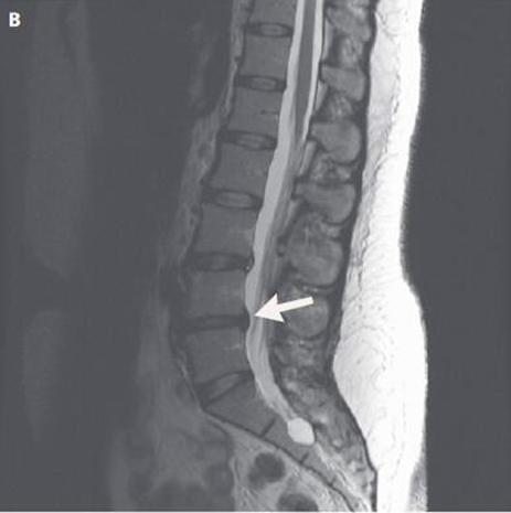 5个月前后两次mri(核磁共振)的对比图:很明显,突出的腰椎间盘有所回纳