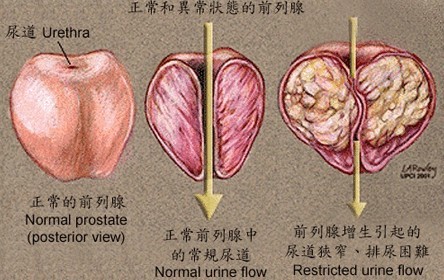 和前列腺炎彻底说"分手"