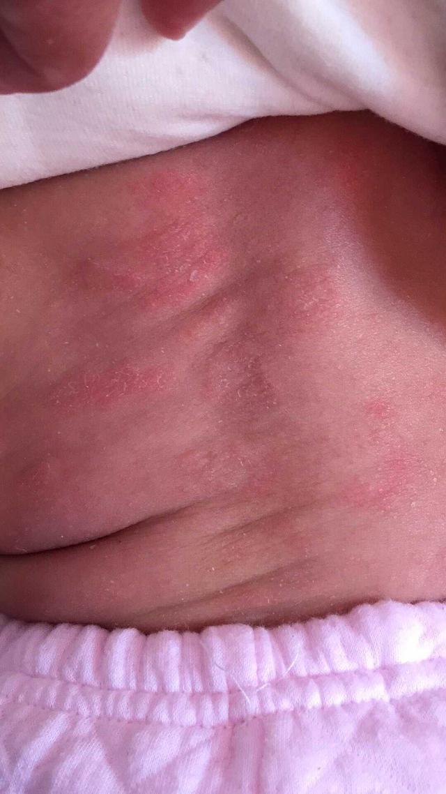 宝妈:宝宝今天四个月了,脸上湿疹反反复复两个多月了,身上半个多月