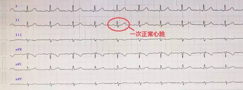 教你轻松读懂心电图