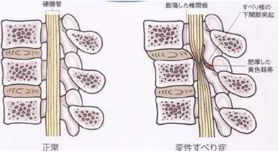 椎管狭窄与腰椎间盘突出关系