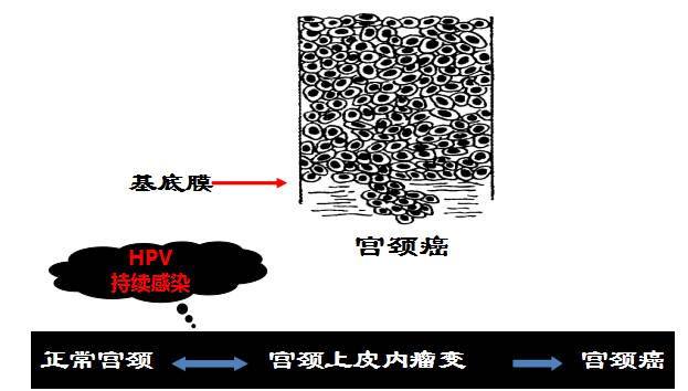 指切除宫颈鳞柱交界移行带周围及其以下的部分锥形组织的一种手术方式