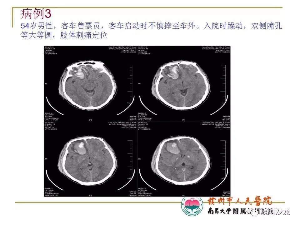 颅脑损伤术中脑膨出原因分析及救治策略