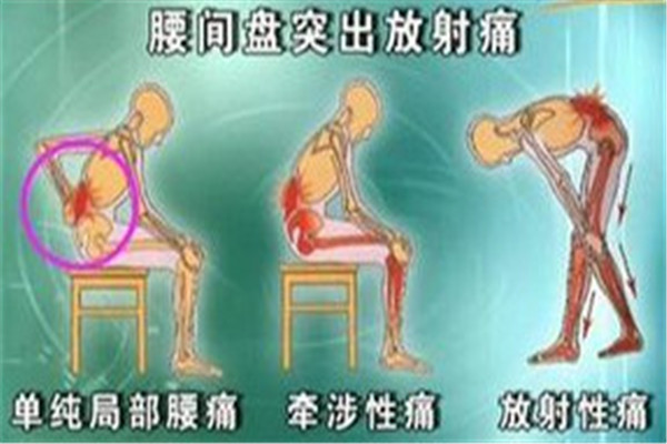 腰间盘突出腿疼怎么治疗?