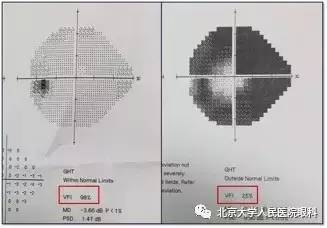 正是因为她的"不在乎",左眼视神经乳头杯盘比从0.3 扩大到0.