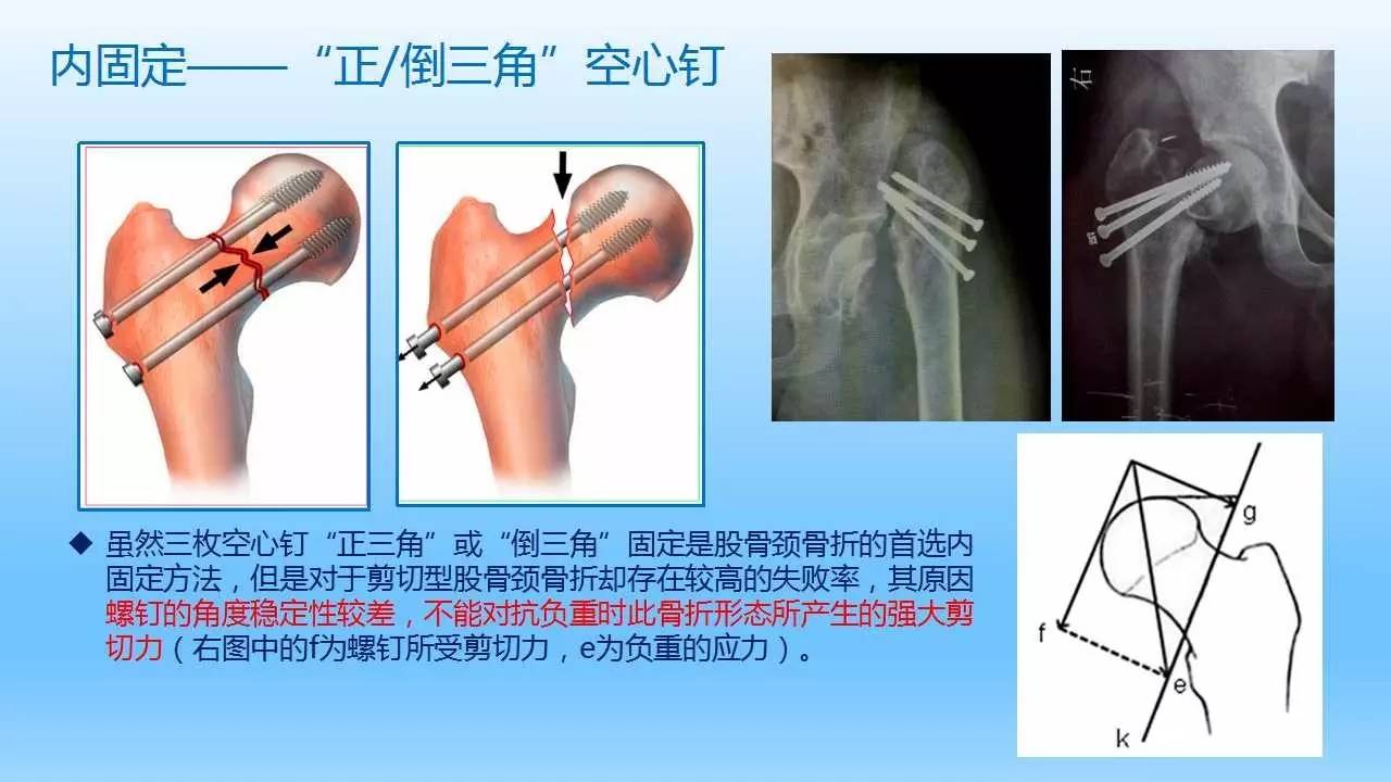 股骨颈剪切型骨折经验分享