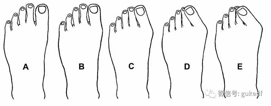 拇趾向外偏斜,拇趾近节趾骨与第1跖骨成角大于15°,有"大脚骨","大觚