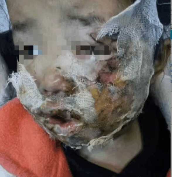 韩国三星手机又爆炸5岁女童脸部严重烧伤惨遭毁容!
