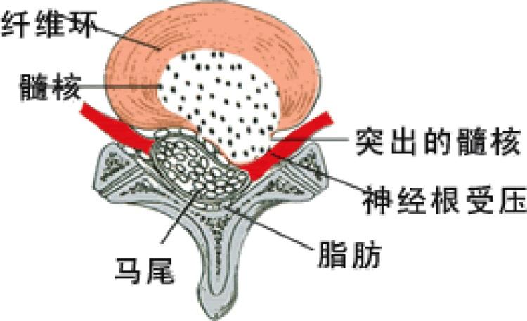 腰椎间盘突出压迫硬膜囊,这样治疗更有效