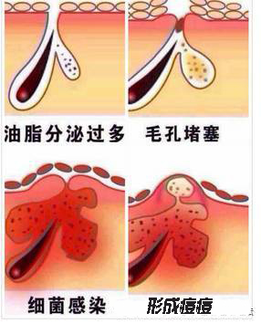 其他相关因素:化妆品使用不当引起的毛囊口堵塞,精神因素引起的内