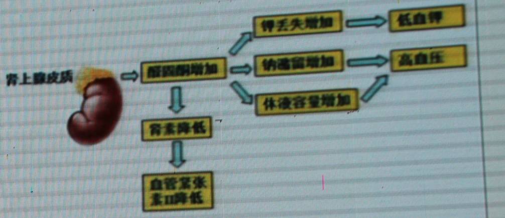 2. 醛固酮瘤单侧发病占90%,60%为肾上腺皮质腺瘤,40%为肾上腺皮质癌.