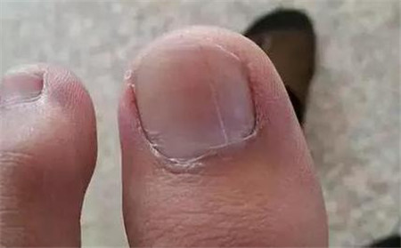 脚指甲顶级内陷:表明心,肝或吸呼系统有疑问.除部分真菌传染外.