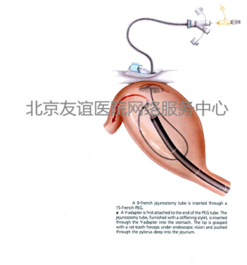 友谊说:经皮内镜下胃造瘘术